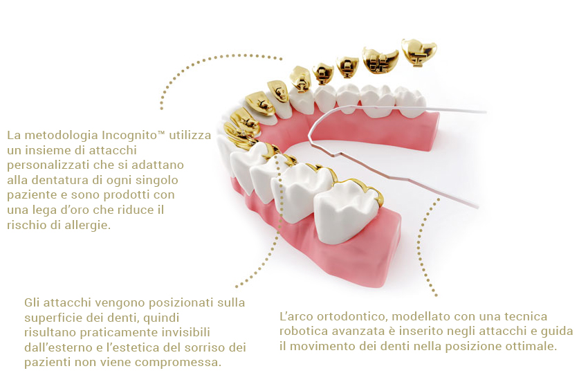 Apparecchio Dentale Incognito™